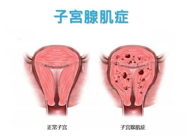子宫腺肌症最新治疗方法探索，小巷深处的秘密小店解密之旅